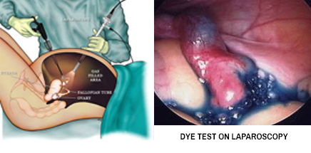 Dye Test on Laparoscopy Treatment | ARMC IVF Salem | Best IVF Clinic in Tamilnadu